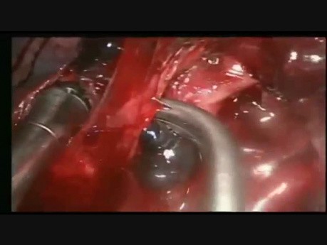 Live Thoracoscopic Surgery Complex VATS Middle Lobectomy due to Hilar Calcified Lymph Nodes