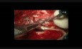 Closed Tympanoplasty of the Right Ear 