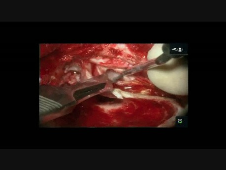 Closed Tympanoplasty of the Right Ear 