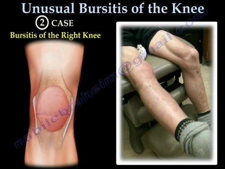 Unusual Bursitis Of The Knee - Video Lecture