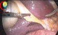 Adhesiolysis to Subphrenic Adhesions to Perform Safe Laparoscopic Cholecystectomy Using the Madany's Triangle Dissection