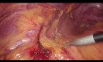 The Moskowitz Artery and Splenic Flexure Mobilization During Laparoscopic Sigmoid Resection