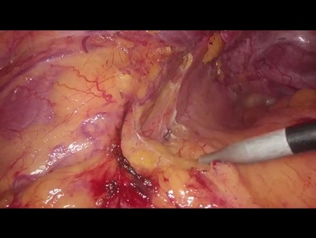 The Moskowitz Artery and Splenic Flexure Mobilization During Laparoscopic Sigmoid Resection
