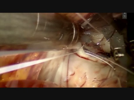 Robotic Repair of Complex Mitral Valve Endocarditis with Pre-operative Embolic Neurologic Events