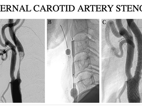 Lecture in Surgery of Arterial Disorders (Narrated)