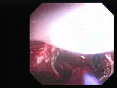 Hemorrhage After Ligation - An Attempt of Coagulation