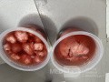 Huge Leiomyoma Uteri