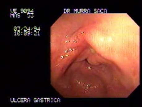 Gastric Ulcer of the Antrum