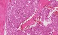 Granulosa cell tumor - Histopathology of ovary