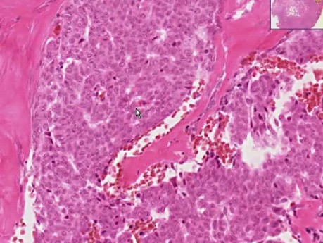 Granulosa cell tumor - Histopathology of ovary