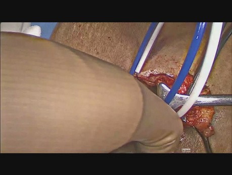Composite Ventral Patch Repair of Umbilical Hernia 