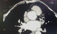 Redo Operation of Coronary Artery Ostia Aneurysm 