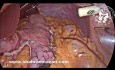 High-pressure Methylene Blue Dye Test During Primary and Revisional Bariatric Surgery