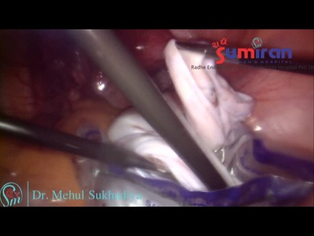 RT Ovarian Cyst - 36 Wks Size