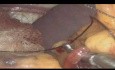 Lap Splenectomy for Splenic Metastasis