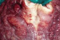 Endoscopy of Scirrhous Gastric Carcinoma involving the entire Fundus, Body and the Antrum (39 of 47)
