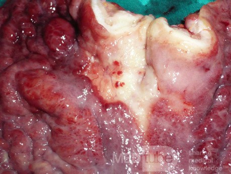 Endoscopy of Scirrhous Gastric Carcinoma involving the entire Fundus, Body and the Antrum (39 of 47)