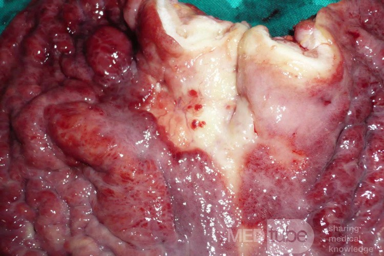 Endoscopy of Scirrhous Gastric Carcinoma involving the entire Fundus, Body and the Antrum (39 of 47)