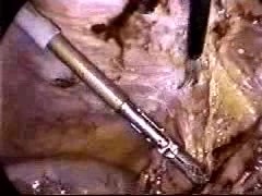 Abdominal Surgery Complications