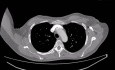 Transaxillary AVR in Patient with Breasts Implants