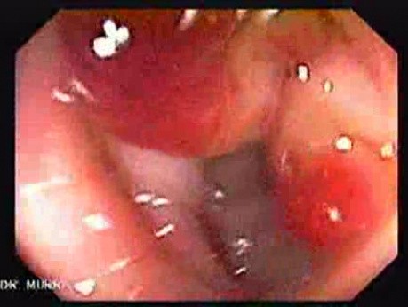 Endoscopic View Of Diverticulitis Of The Sigmoid (2 of 4)
