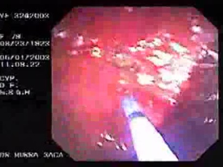 Dieulafoy´s Lesion (Exulceratio Simplex) (3 of 6)