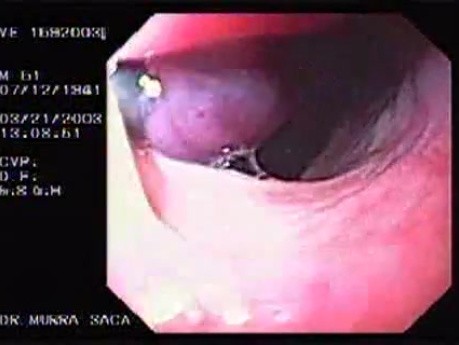 Banding of esophageal varices (6 of 17)