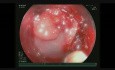 FTR - Residual Rectal Adenoma with Several Fibrosis