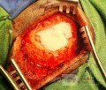 Epicranial Tumor Injury