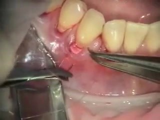 Root Coverage