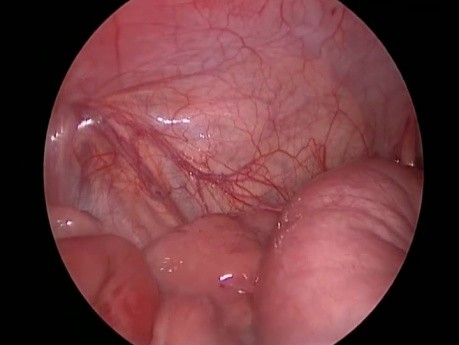 Laparoscopic Reduction of Ileocecal Intussusception in Infant