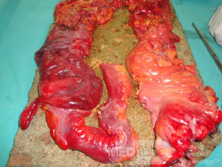 Multiple Rectal Ulcers (74 of 110)