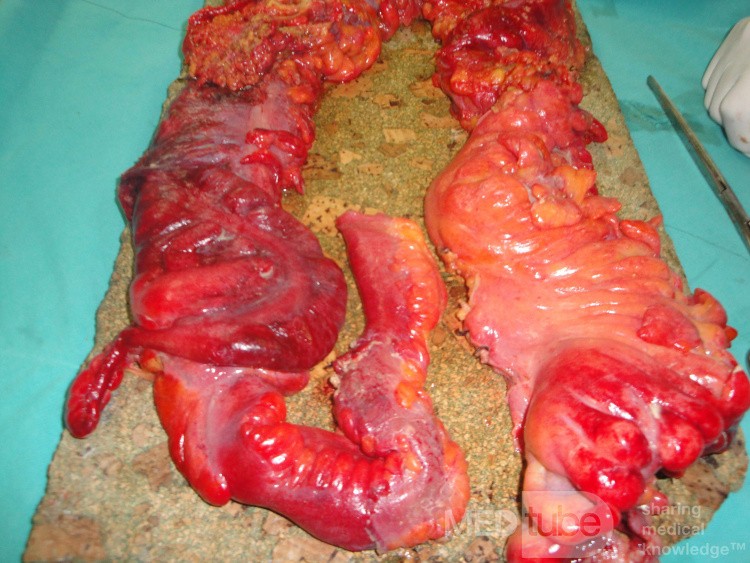 Multiple Rectal Ulcers (74 of 110)