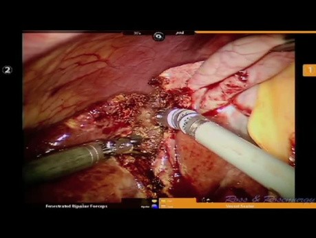 Robotic Liver Resection