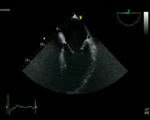 Mitral Regurgitation