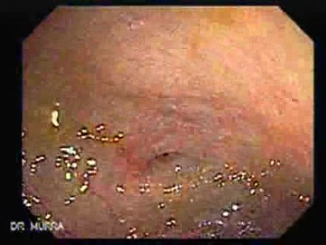 Trichuris Trichura (whipworm) (3 of 3)