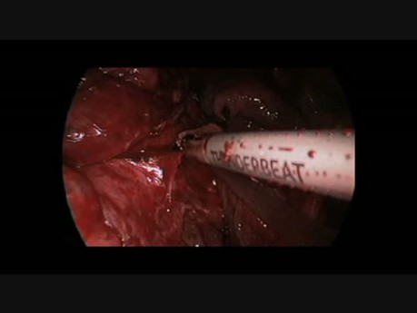 Uniportal VATS Lower Lobectomy Adenomatoid Cystic Malformation And Bronchial Atresia