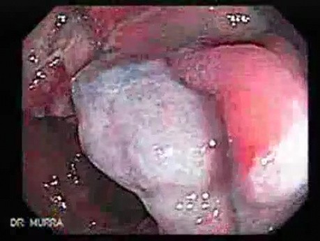 Cap polyposis that resemble a adenocarcinoma of the rectum (4 of 7)
