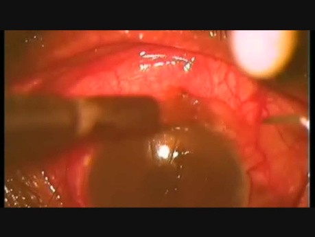 Microtrack Filtration at the Lower Limbus, Because the upper Limbus Was Completely Scarred
