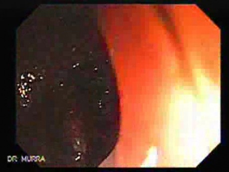 Sigmoids Adenocarcinoma (1 of 2)
