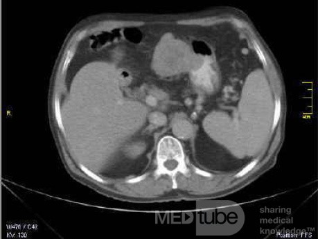 Gastrointestinal Stromal tumor (GIST) (12 of 13)