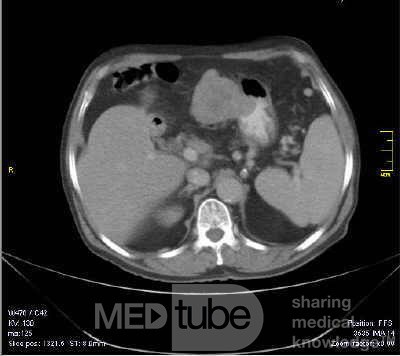 Gastrointestinal Stromal tumor (GIST) (12 of 13)
