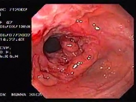 Crohn's Disease - Endoscopy (14 of 28)