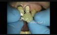 Immediate Dental Implant Provisional