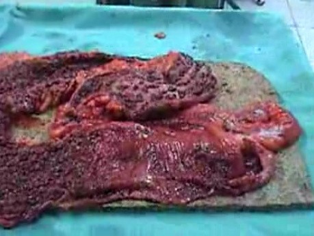 Multiple Rectal Ulcers (65 of 110)