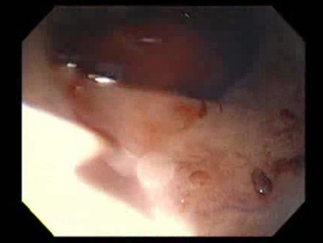 Bleeding Due to Dieulafoy´s Lesion (6 of 8)