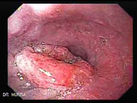 Adenocarcinoma of the Cardia and Fundus (1 of 2)