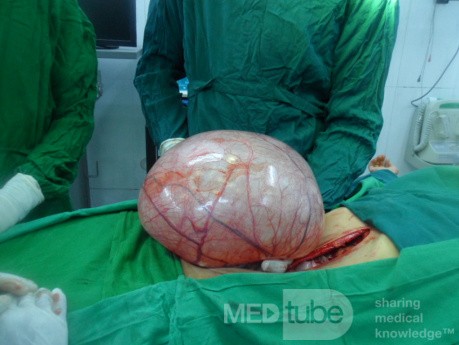 Huge left ovarian cyst 