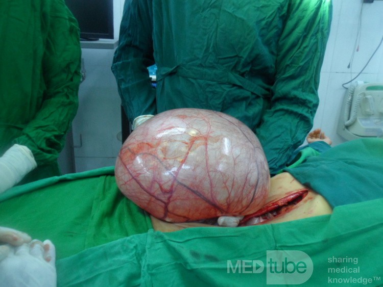 Huge left ovarian cyst 