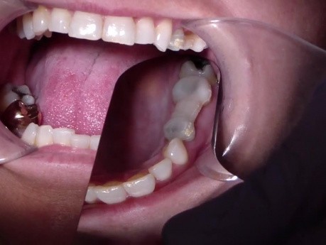 Bridge Insert: Strengthen Your Provisional Fdp With Ribbond